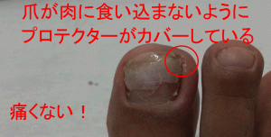 巻き爪の治療＠東京。そめのまち診療所での治療中の私の右足。こっちは重症。
