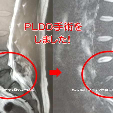 腰椎椎間板ヘルニア　レーザー手術（PLDD手術）体験談